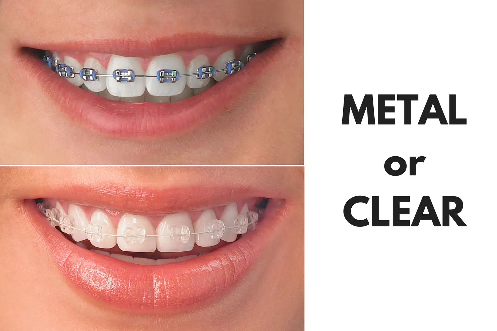 Should I Get Metal or Clear Braces? - General Dentist