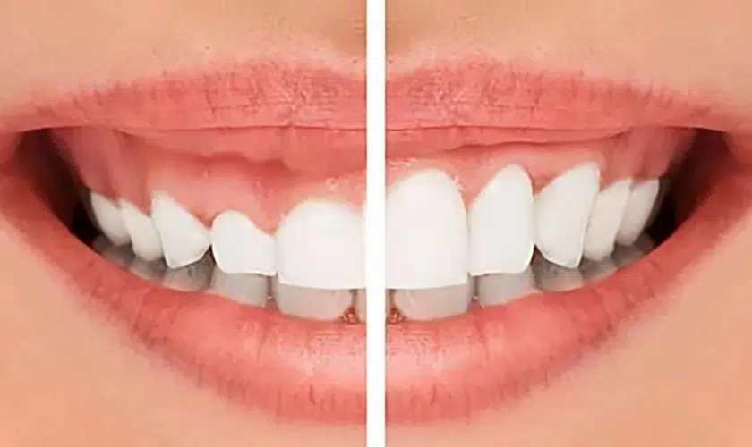 Adding Gum Contouring to Your Full Smile Makeover
